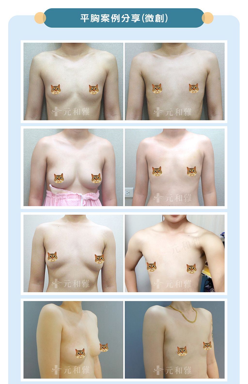 平胸手術/術前術後